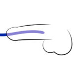 Silikone Dilator Sæt med 3 stk Blå